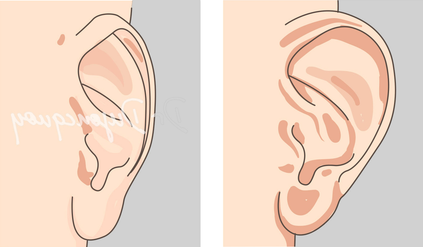 Les oreilles décollées