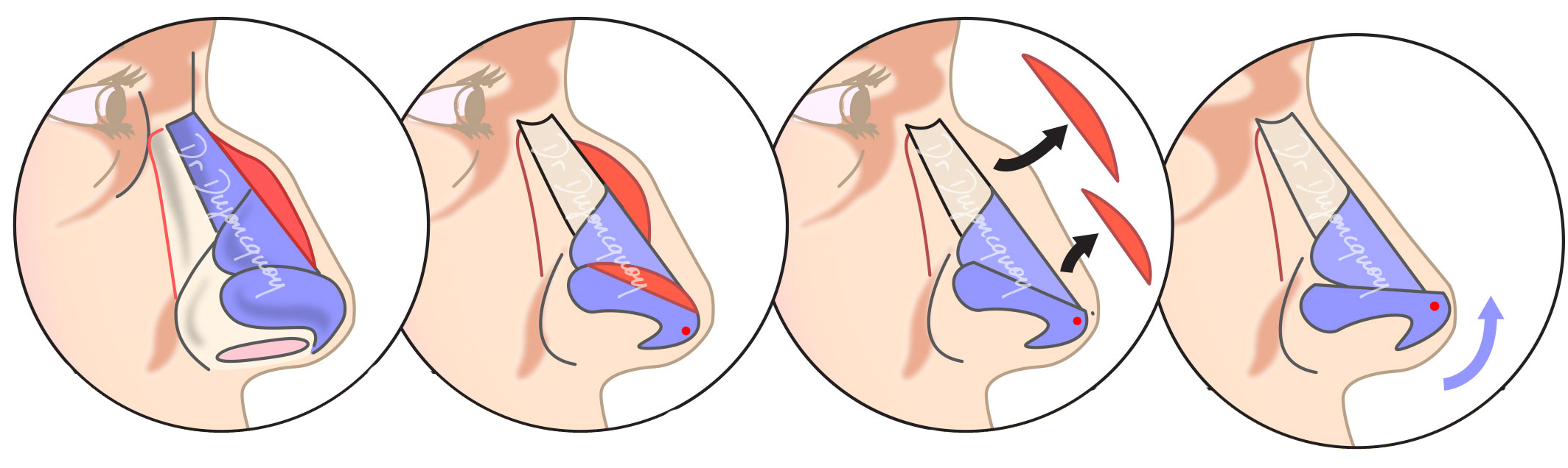 Chirurgie Rhinoplastie - Chirurgie Esthétique du Nez Paris