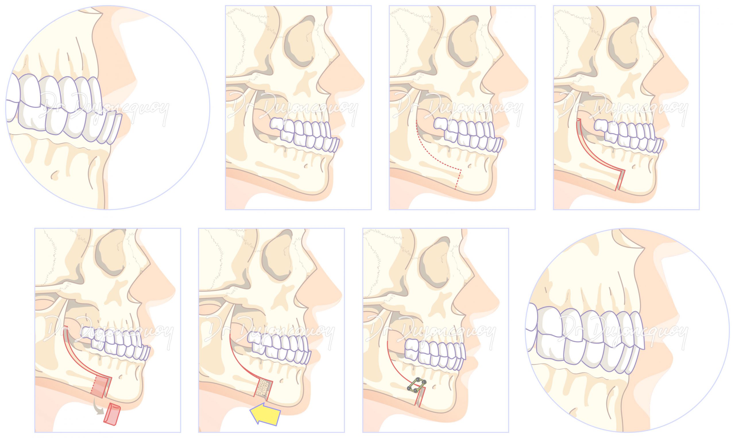 Chirurgie Orthognathique - Chirurgie Esthétique Mâchoire Paris