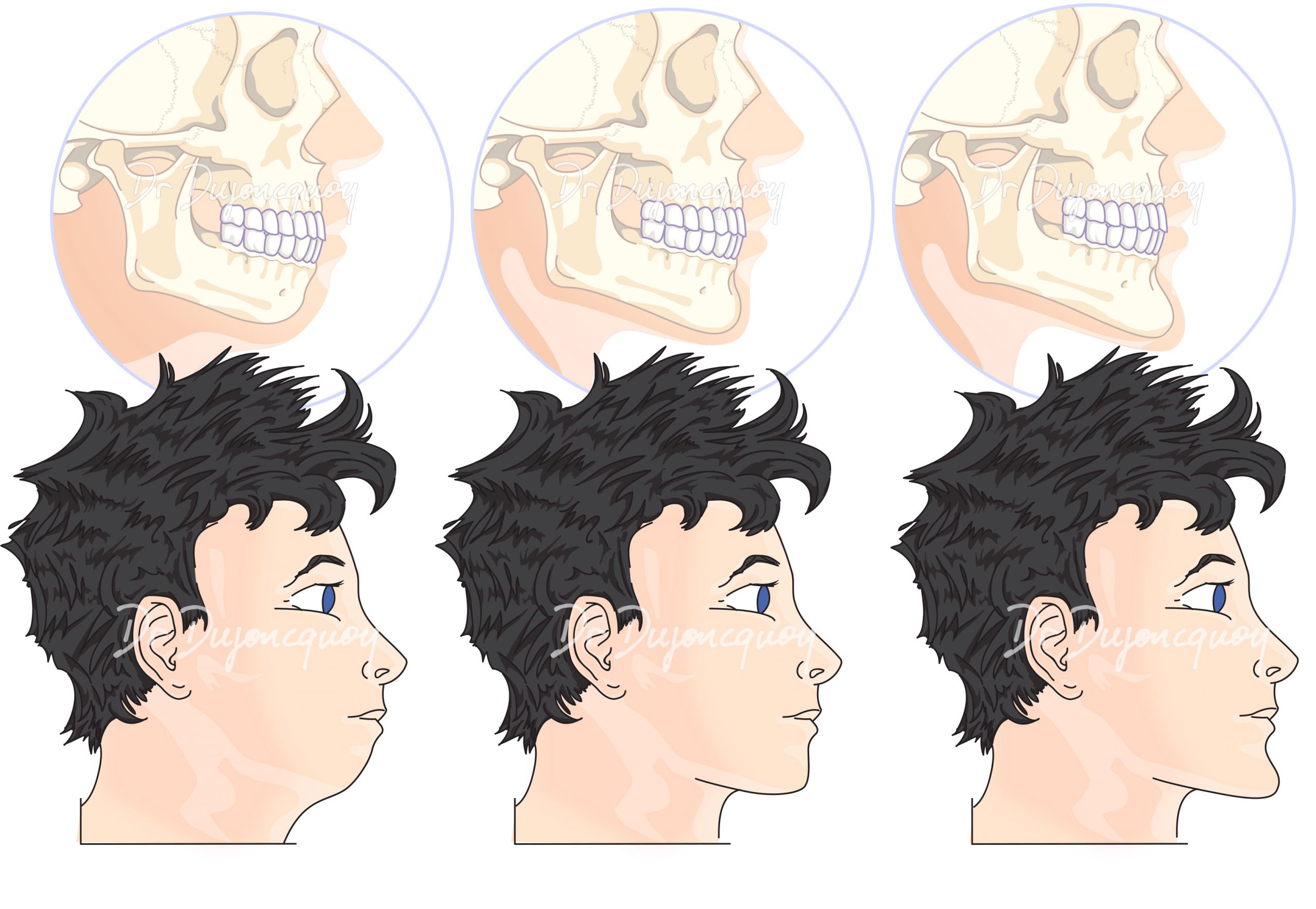 Génioplastie - Chirurgie Esthétique du Menton par Génioplastie Paris