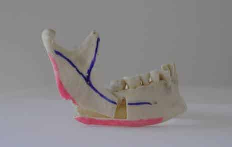 Ostéotomie sagittale modifiée avec abaissement des angles mandibulaires 2