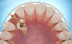 Dégagement et collage de canine