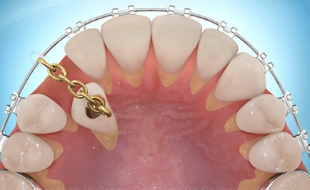 Dégagement et collage de canine