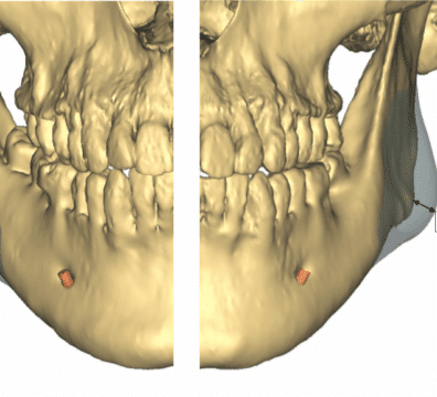 Prothèses en titane 3D