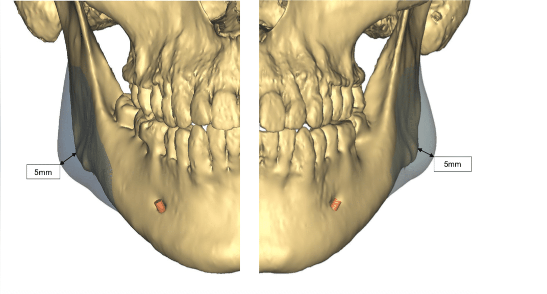 Prothèses en titane 3D