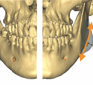Réduction des angles mandibulaires