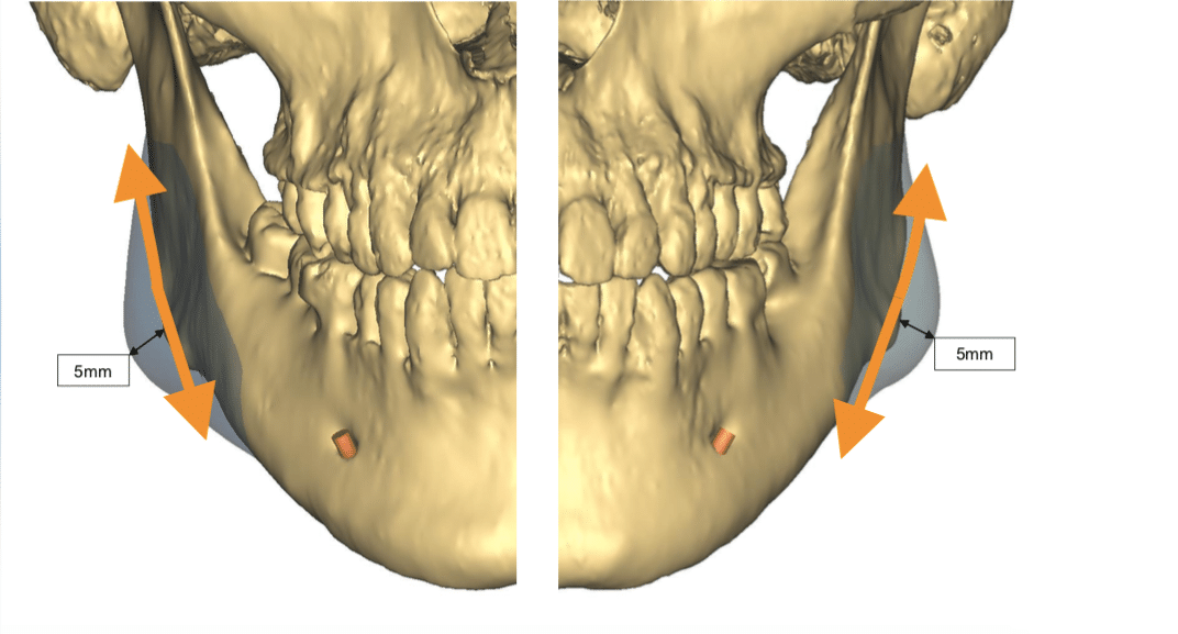 Réduction des angles mandibulaires