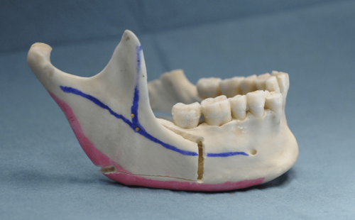 Ostéotomie sagittale modifiée avec abaissement des angles mandibulaires