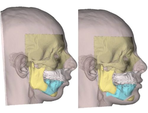 Ostéotomie bi-maxillaire avec rotation anti-horaire